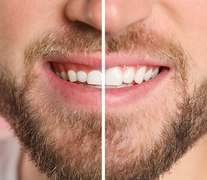 Young man before and after gingivoplasty procedure, closeup