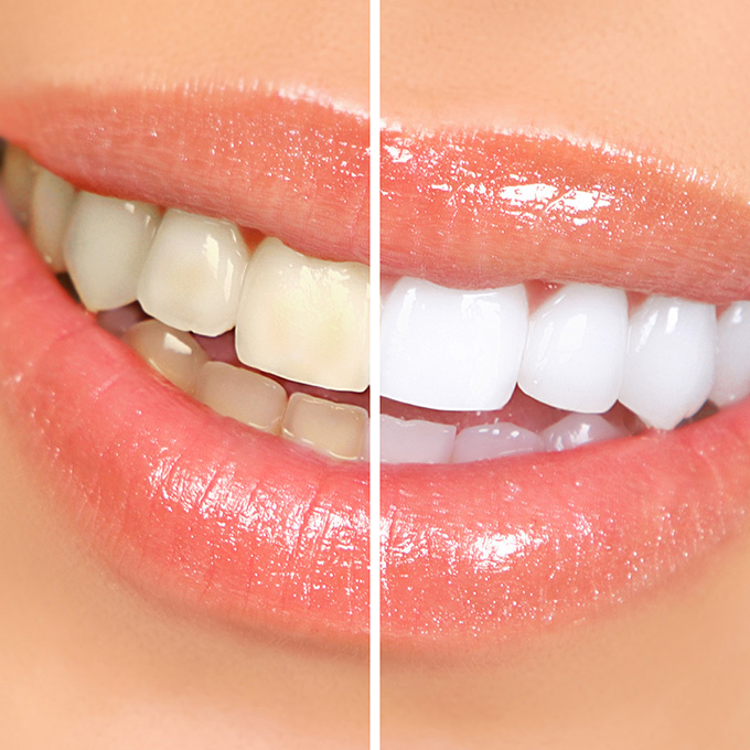 A woman's teeth pre and post whitening