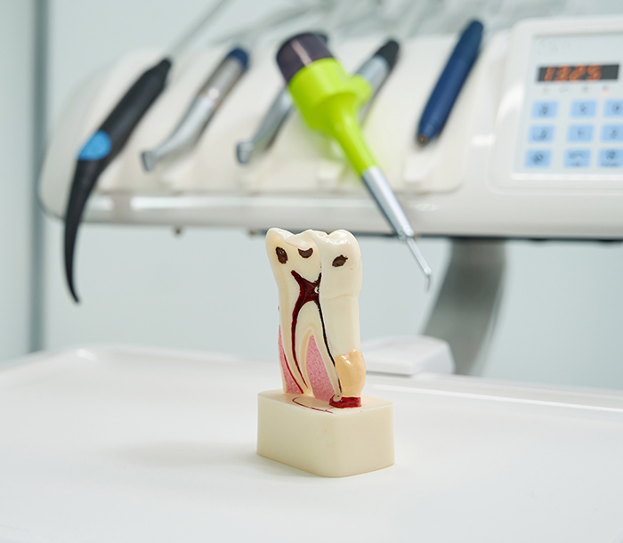 Close-up of tooth model with root canals and caries