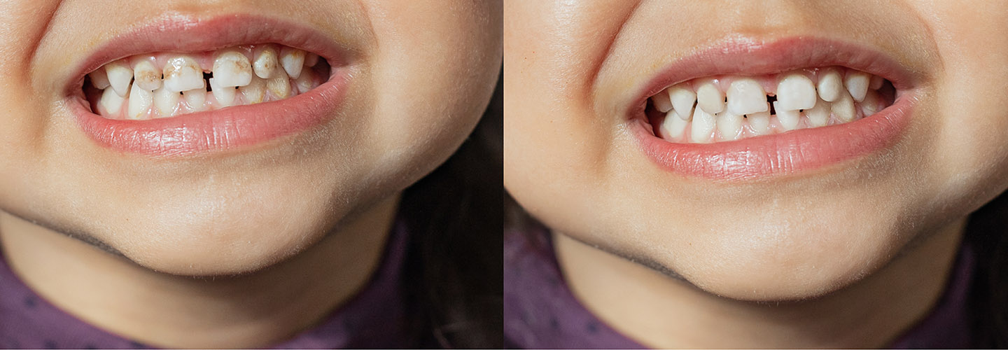 The child shows milk teeth with stains and plaque close-up. Two photos before and after. Children's dentistry. Health and dental care, caries treatment, baby teeth. Dark spots on teeth