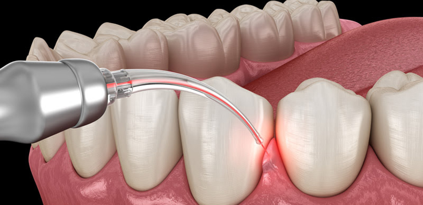 PeriLaser used on enflamed gums