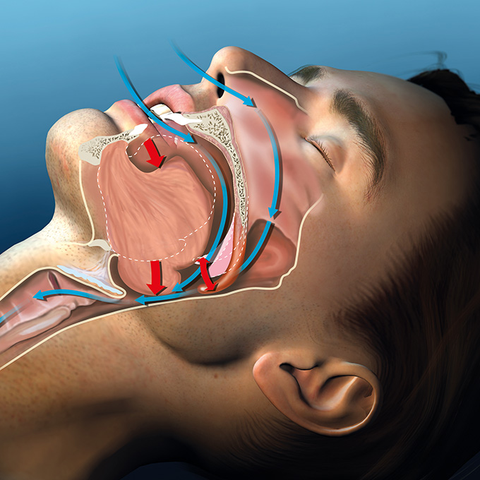 Snoring, medical illustration