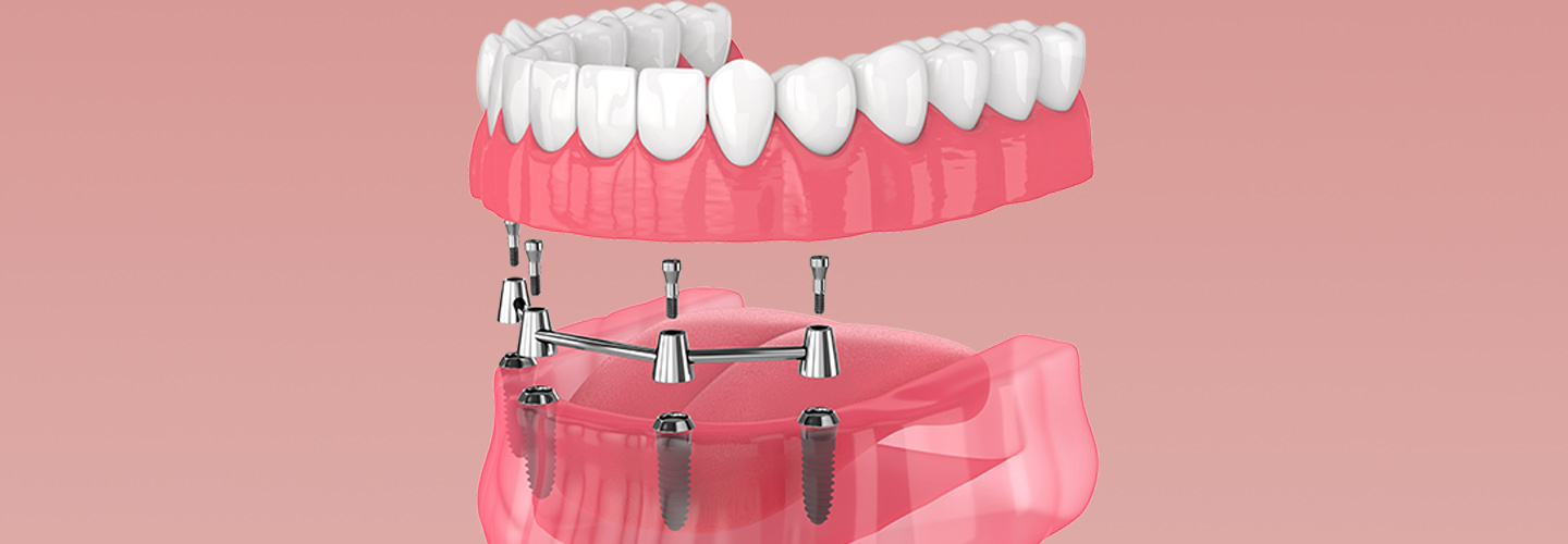 Implant supported dentures